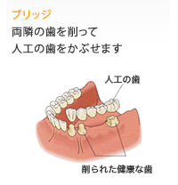 ブリッジ
両隣の歯を削って人工の歯をかぶせます。