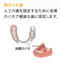 部分入れ歯
人工の歯を固定するために金属のバネで健康な歯に固定します。