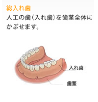 総入れ歯
人工の歯(入れ歯)を歯茎全体にかぶせます。