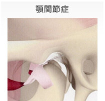 顎関節症